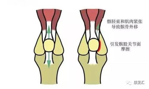 【保护关节】缓解髌骨股骨疼痛,锻炼臀部肌肉是关键!