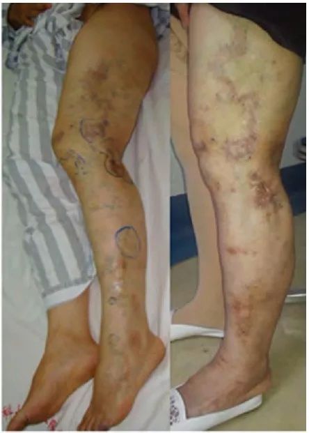 患者1,男,右下肢kts,治疗前右大腿及小腿见畸形曲张静脉,患者行4次