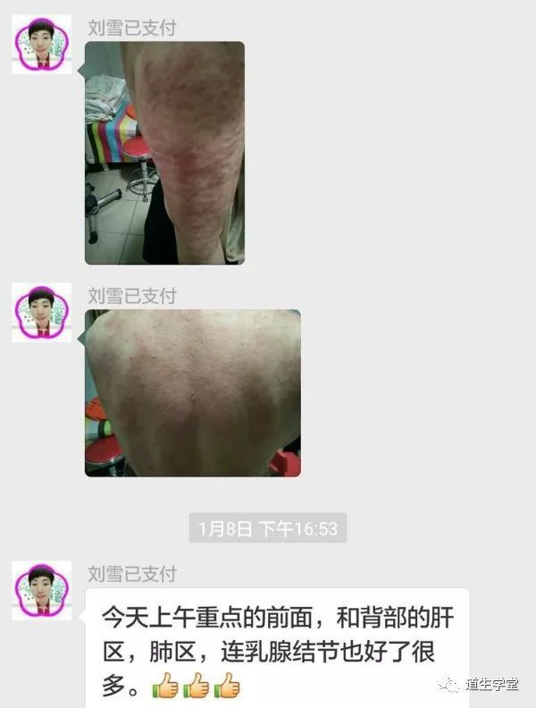 14,看看我滴痧像图,乳腺结节也好多了