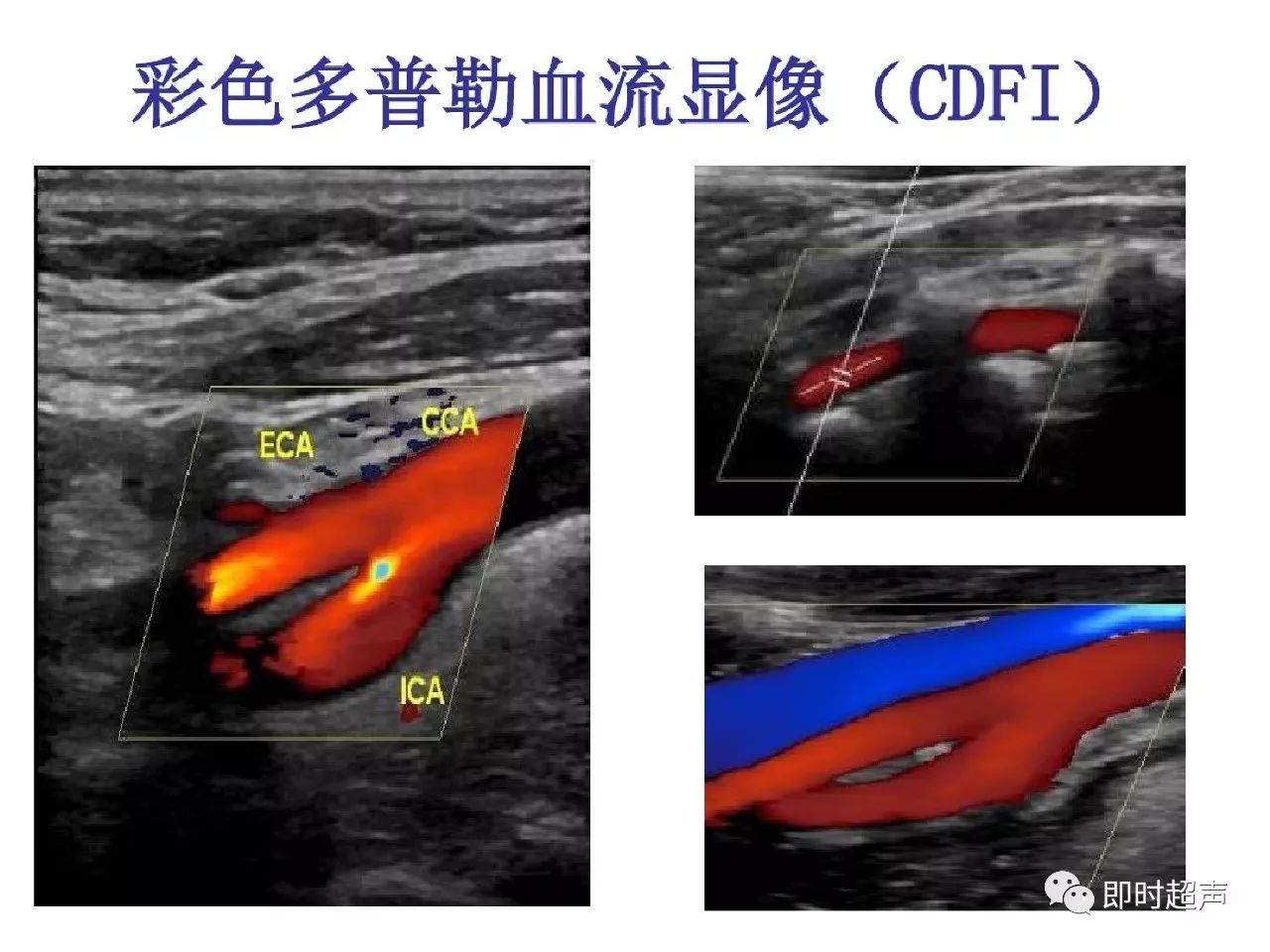 颈部血管超声正常解剖及常见病的超声诊断标准