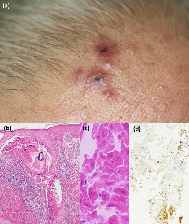 水痘-带状疱疹病毒(vzv)抗原的免疫组化染色示毛囊上皮阳性(图 1d).