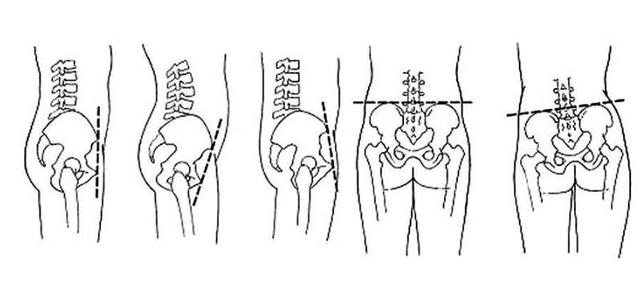 直腿筷袜:矫正骨盆不正拉伸运动,不仅让腿型更美,还能