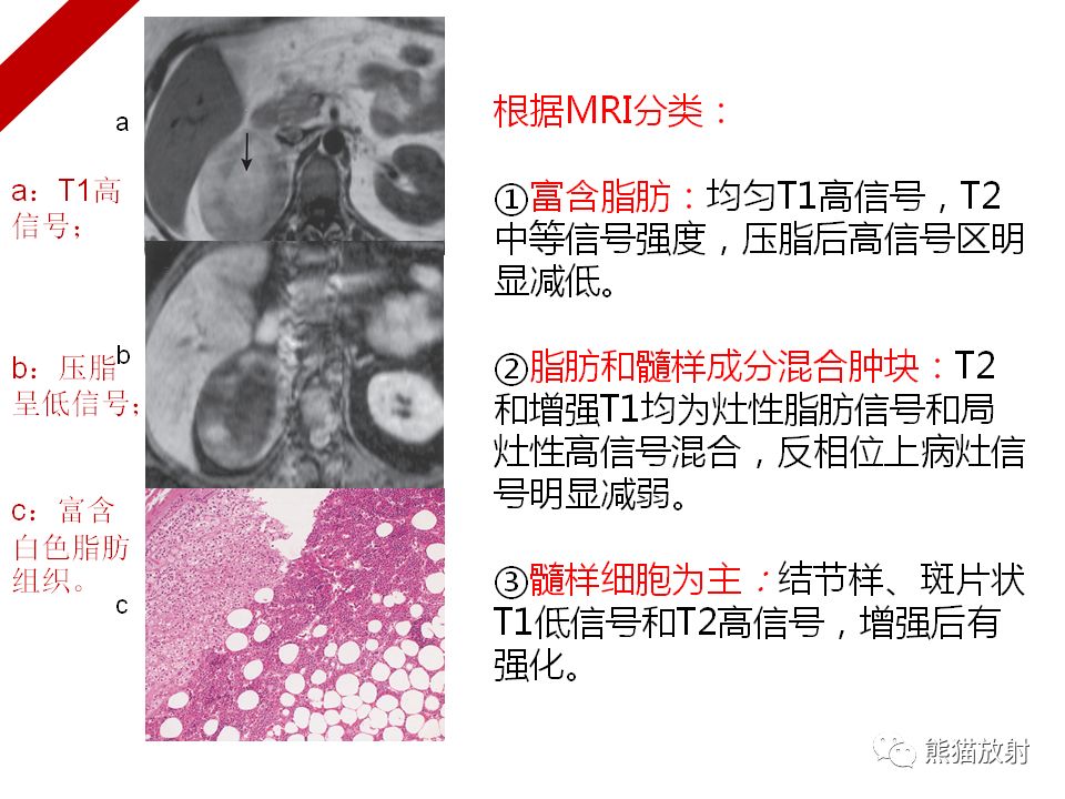 肾上腺非功能性病变丨影像表现(ct,mri,pet-ct)