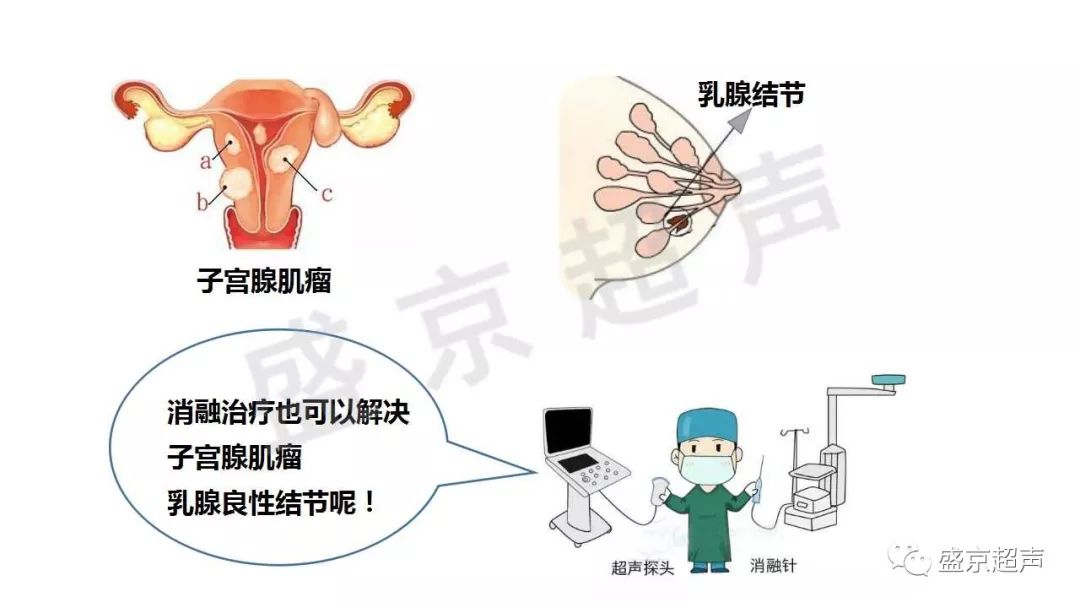 漫画解读:介入超声能做啥?