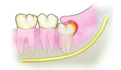 智齿因阻生而牙冠不能完全外露,牙冠周围的牙龈黏膜下(盲袋)极易积存