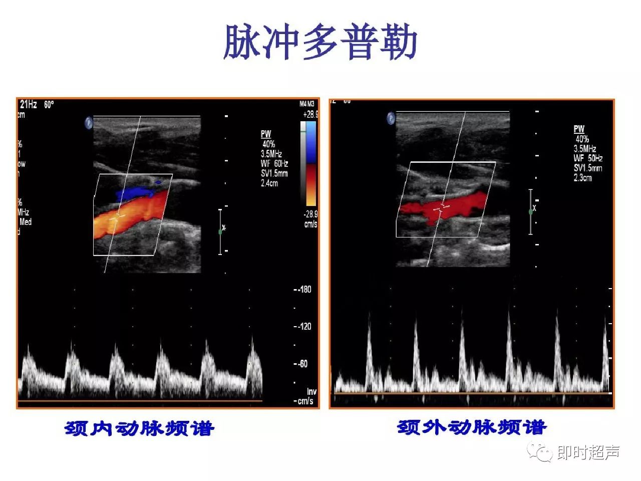 颈部血管超声正常解剖及常见病的超声诊断标准