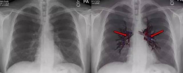 f(fissures)肺裂将各肺分为各叶,左右各有一斜裂,右侧有横裂,斜裂下端