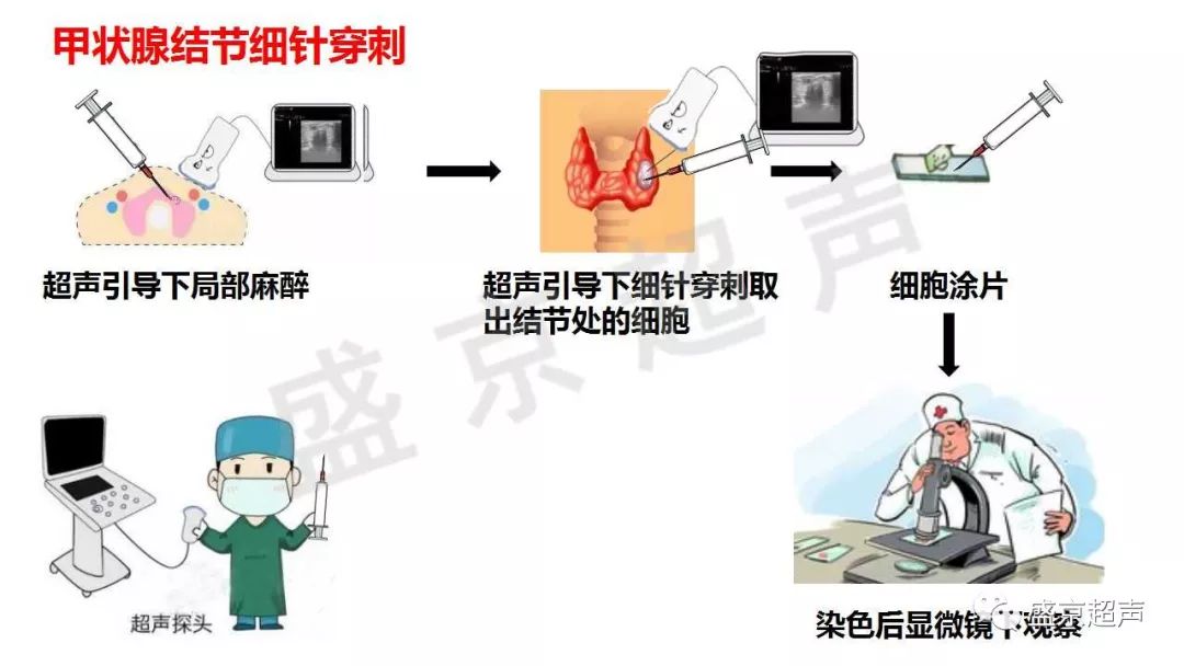 漫画解读:介入超声能做啥?