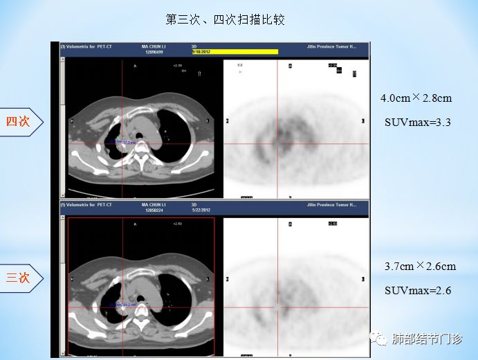 ### Understanding PET CT Side Effects: What You Need to Know