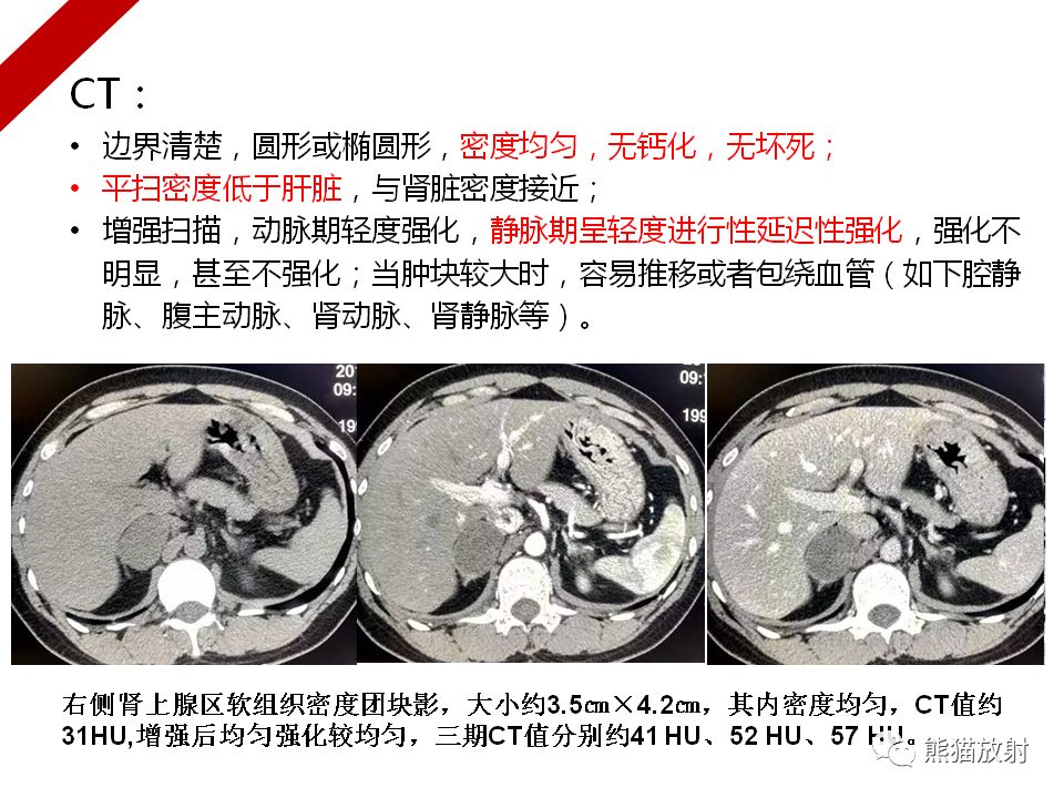 肾上腺非功能性病变丨影像表现(ct,mri,pet-ct)