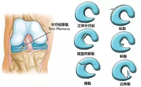 桶柄型:为内侧半月板纵行破裂,裂口可大小各异,并有呈横裂.