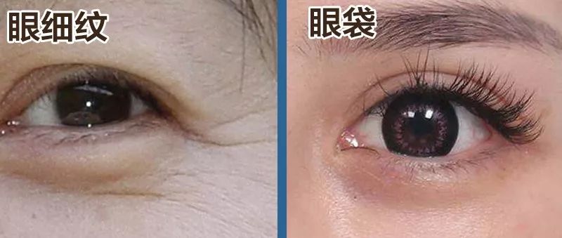 真性皱纹: 眼袋通常指下眼睑浮肿,是由于下睑皮肤松弛,眼底脂肪堆积