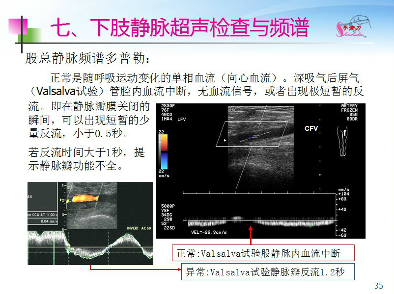 下肢血管的超声检查及正常声像图