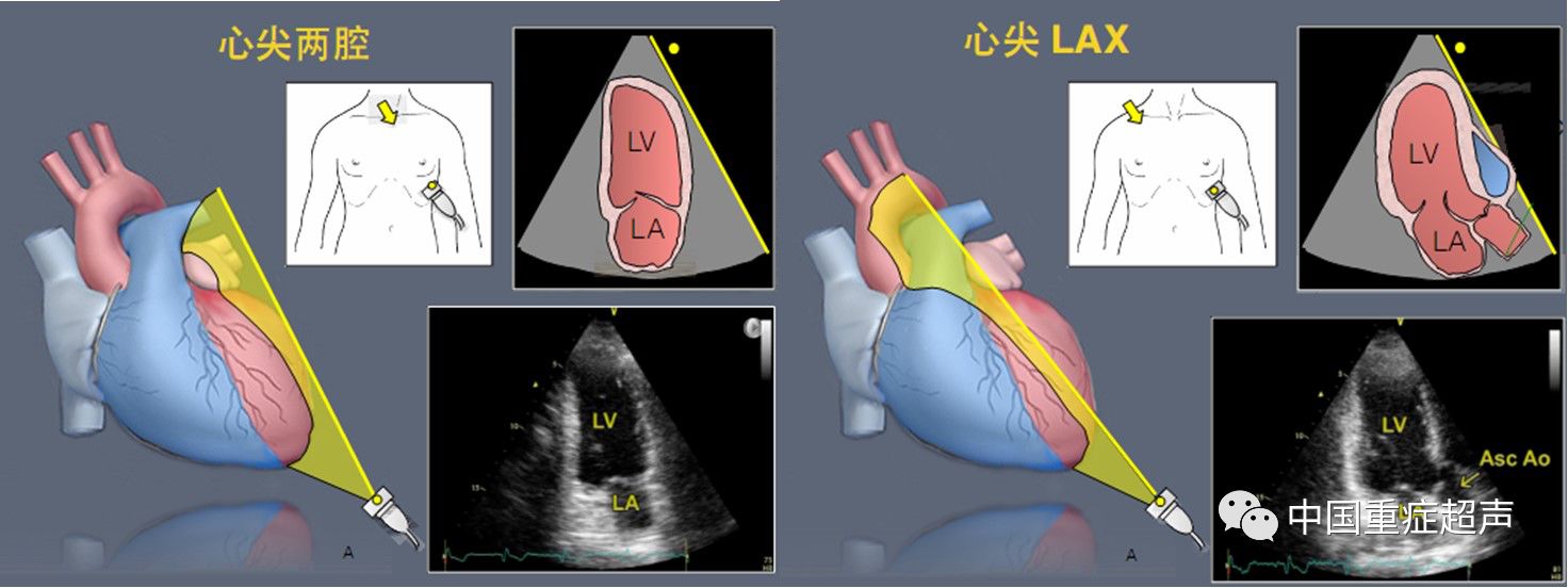 重症超声心脏基础理论-经胸心脏超声基本平面(2)
