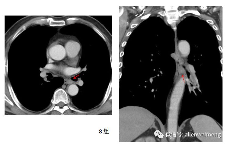 韧带淋巴结如图,上界为下肺静脉,下界为横隔下肺韧带是一双层胸膜结构