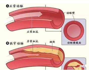 高血脂怕个啥艾灸四个穴位效果显著