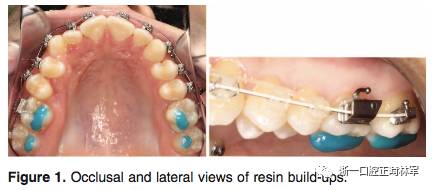 正畸文献阅读--后牙垫高治疗骨性开合成年患者的疗效