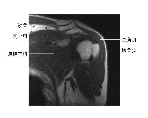 肩关节冠状面(5)