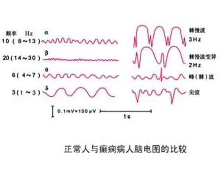 为什么癫痫病人要做脑电图检查便于分型鉴别为明确诊断提供依据