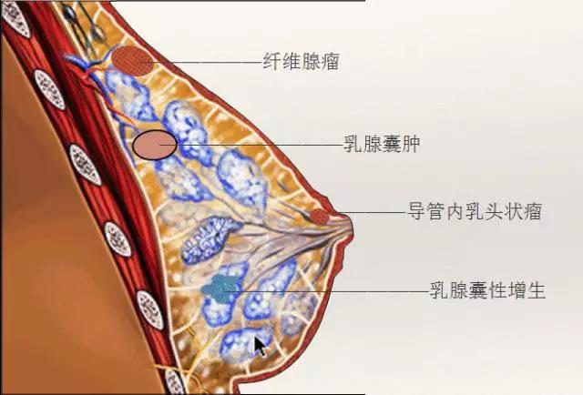 在未婚未育的女性身上,常会表现为乳腺胀痛,疼痛部位以双侧乳房多见