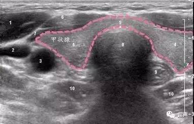 教你看懂甲状腺超声