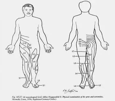 弯与突出类型的关系伸腰屈髋屈膝腰椎间盘突出症典型体位7,反射异常6