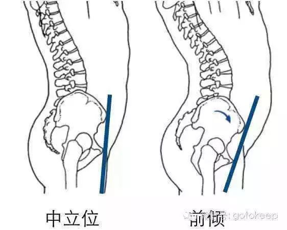 骨盆前倾对比