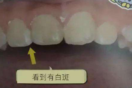 蛀牙造成牙齿缺损的伤害是不可逆的,而出现白斑的牙齿脱钙通过涂氟是