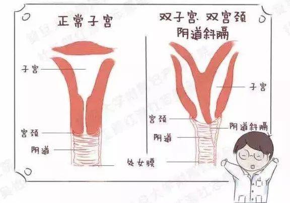 两个子宫一个肾 | 一例成功的阴道斜隔切除手术