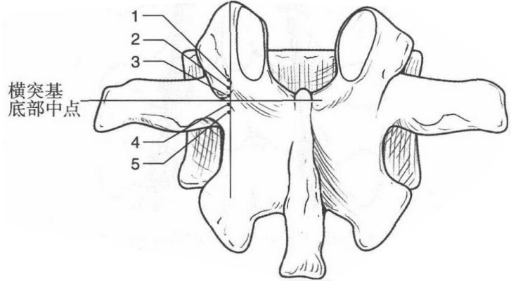 dick进针定位法 术前x线片 正位:了解椎弓根的位置,初步定位.