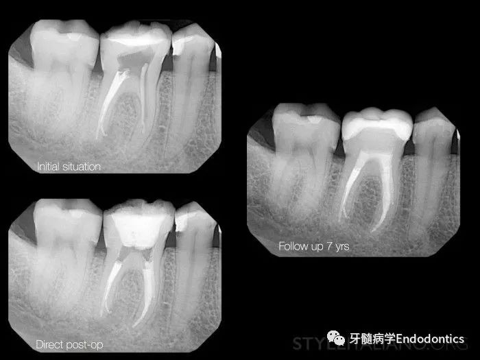 【牙医学堂】根管台阶处理操作要点