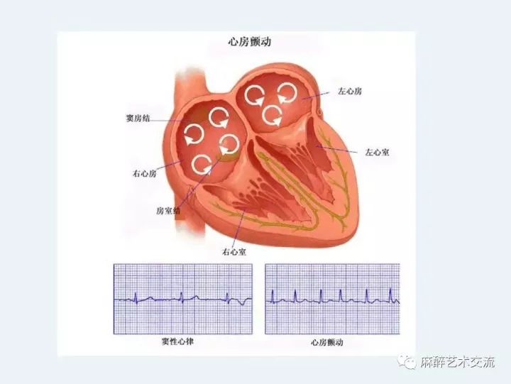 【知识科普】心房颤动(房颤)