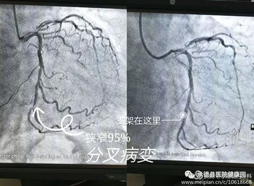 承德县医院内一科成功为三支血管病变患者解除心脏疼痛