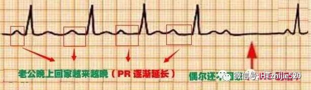 二度i型房室传导阻滞2知识点:p-r间期持续>0.