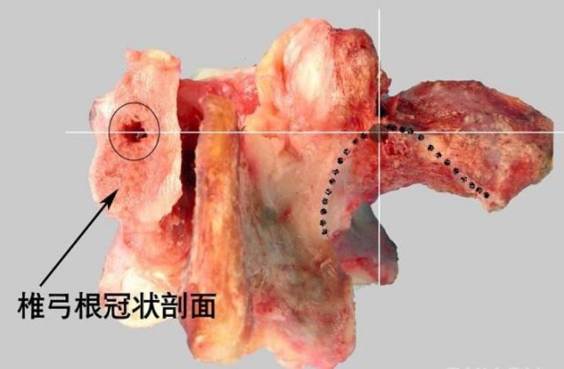乳副突间凹 胸椎 dick进针定位法 术前X线片 正位:了解椎弓根的位置