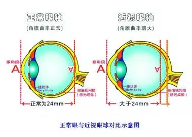 健康 正文  陈岩解释, 近视度数受两个参数的重要影响,一个是眼轴长度