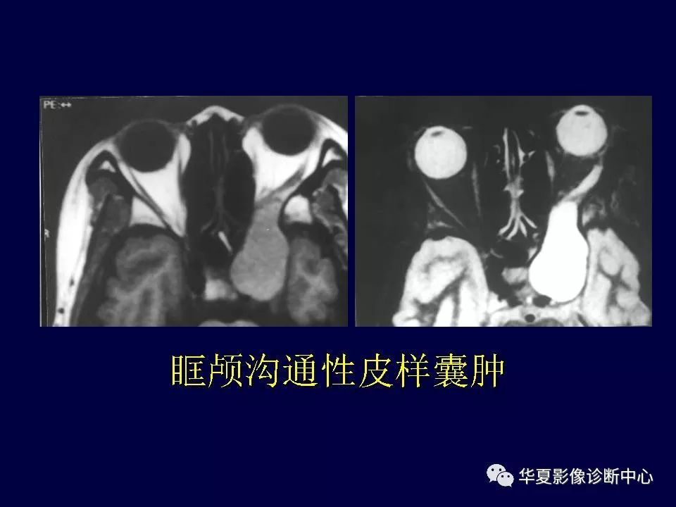 眼眶解剖基础与影像学定位诊断