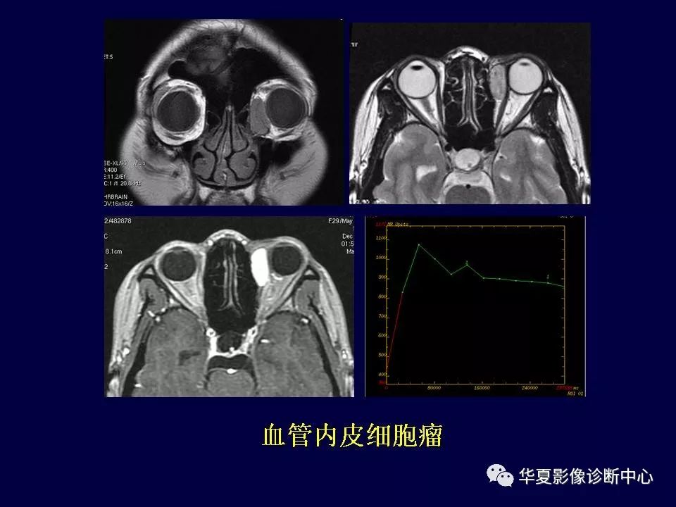 眼眶解剖基础与影像学定位诊断