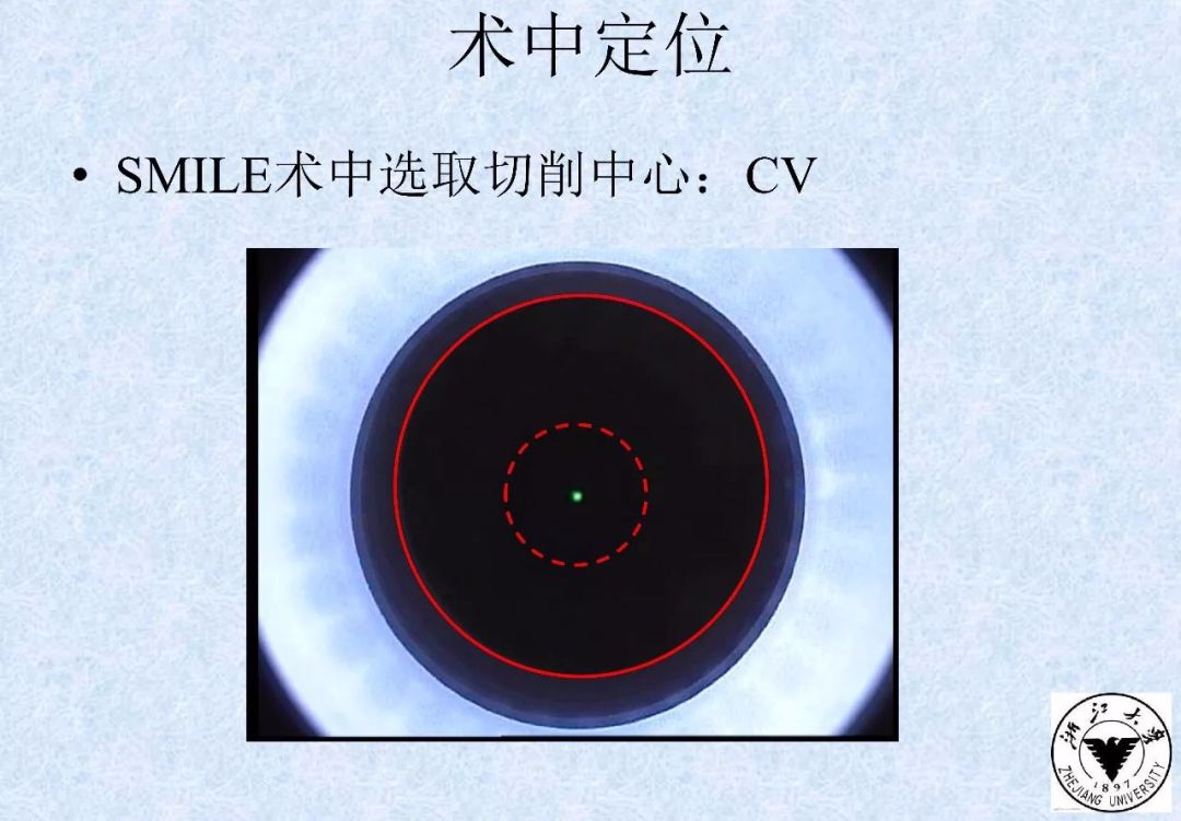 如何安全做好smile手术?