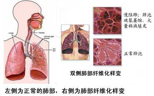 空气环境污染的持续,患呼吸系统疾病,间肺,肺纤维化的患者越来越多了