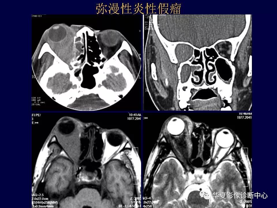 眼眶解剖基础与影像学定位诊断