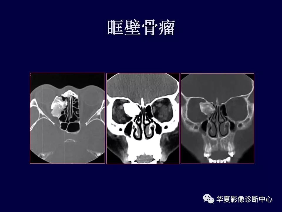 眼眶解剖基础与影像学定位诊断