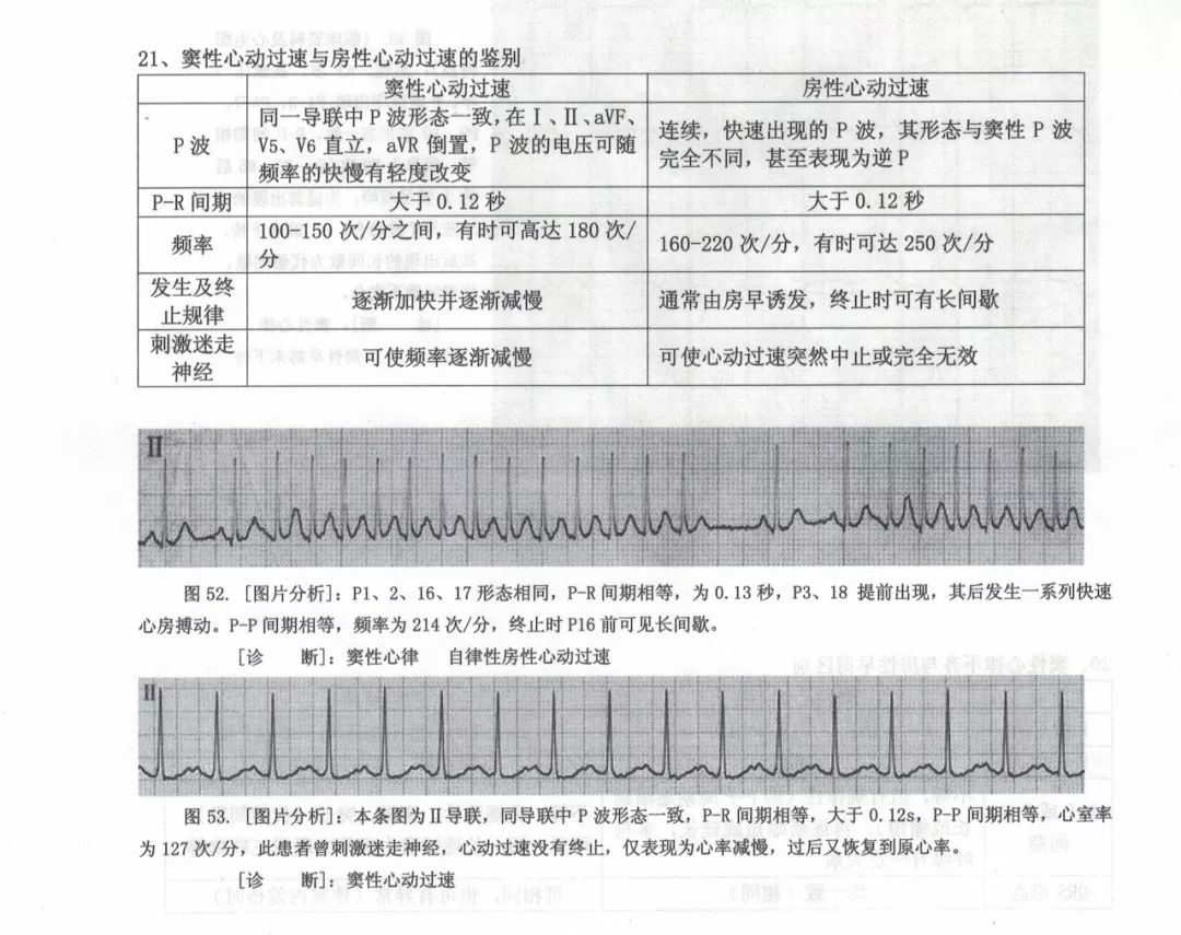 心电图的鉴别诊断图片解读