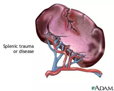 脾脏外伤破裂示意图