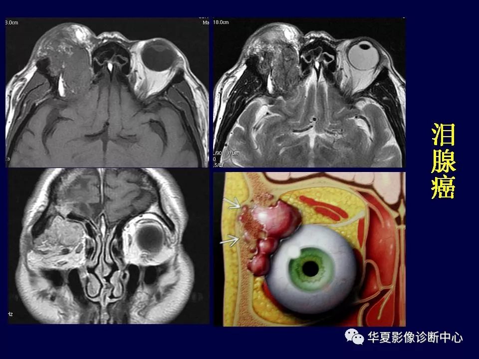 眼眶解剖基础与影像学定位诊断