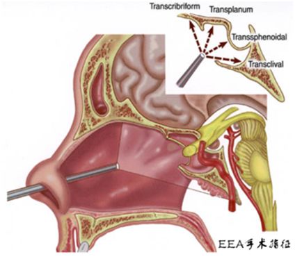 此项技术是利用神经内镜技术,通过鼻腔经蝶筛入路对患侧视神经管的下