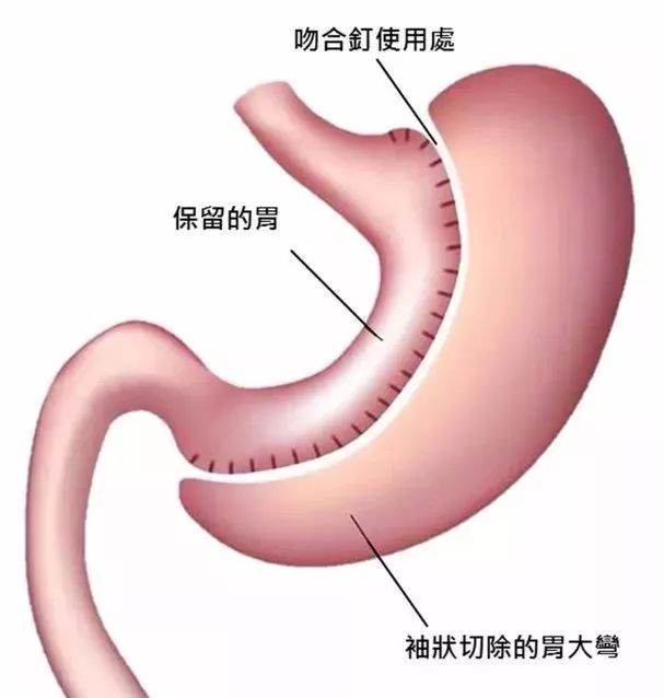 手术减肥_减肥手术有什么危害_减肥手术多少钱