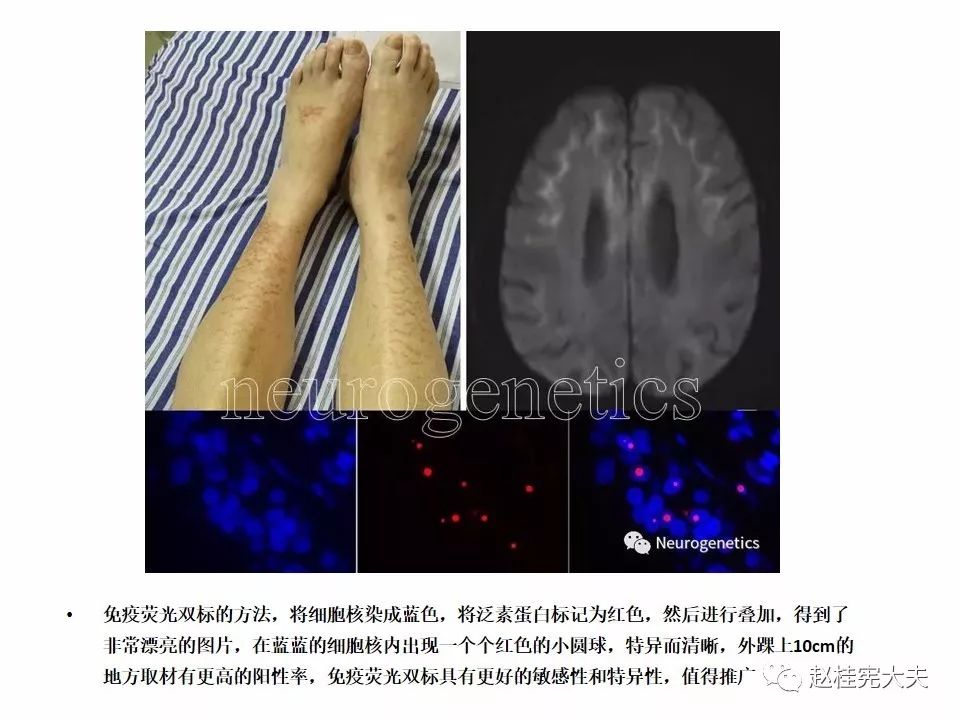 神经元核内包涵体病(niid)最新更新内容!