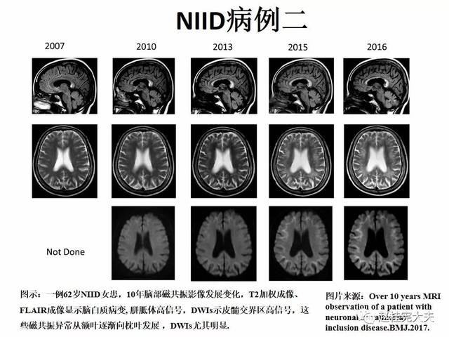 神经元核内包涵体病(niid)最新更新内容!