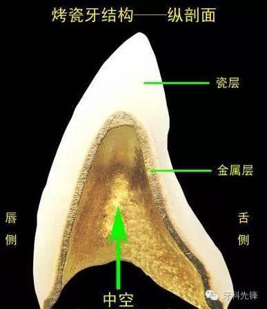 烤瓷牙结构图